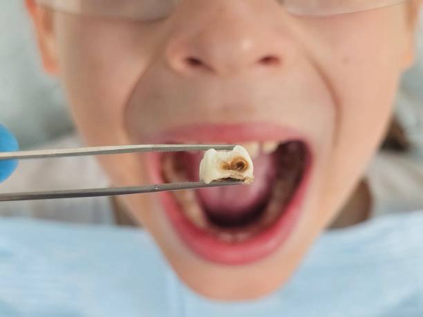 Best Emergency Wisdom Teeth Removal in El Reno, OK